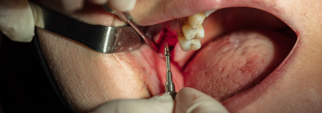 Bone Grafting