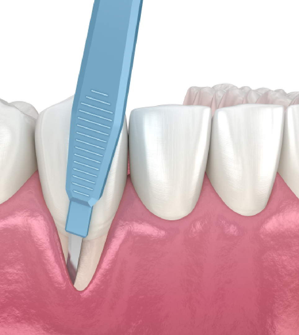 Gum Recession Surgery