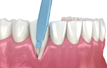 Gum Recession