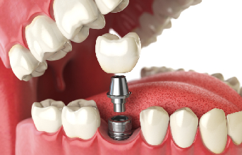 Dental Implants