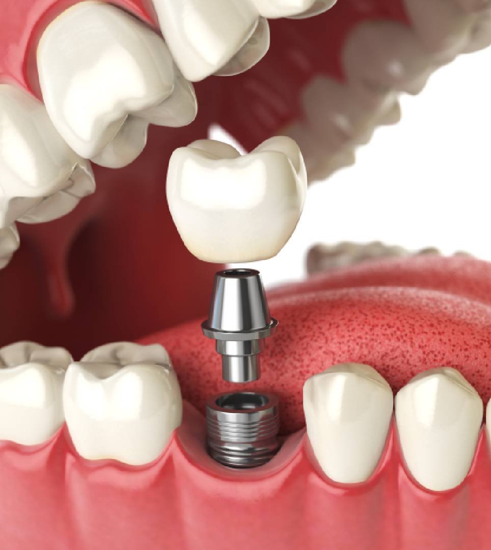 Dental Implants