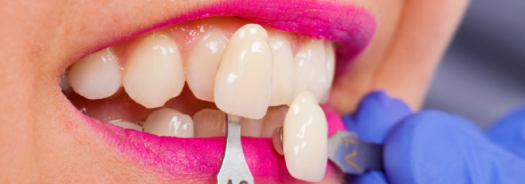 Porcelain Veneers