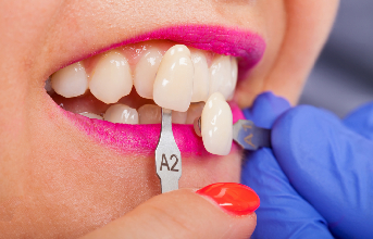 Porcelain Veneers