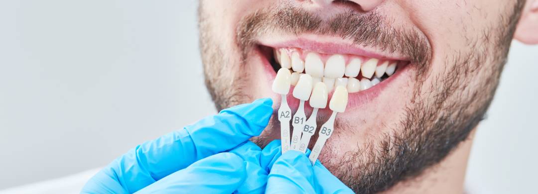 Veneers